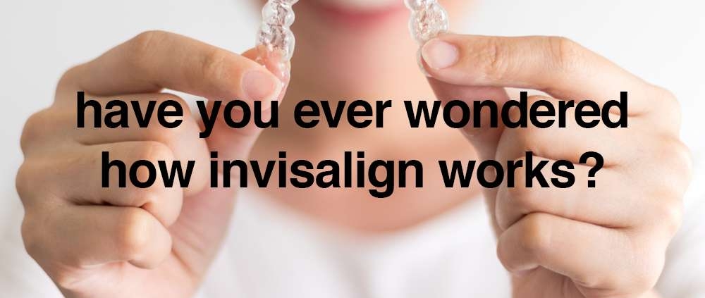 have you ever wondered how Invisalign works