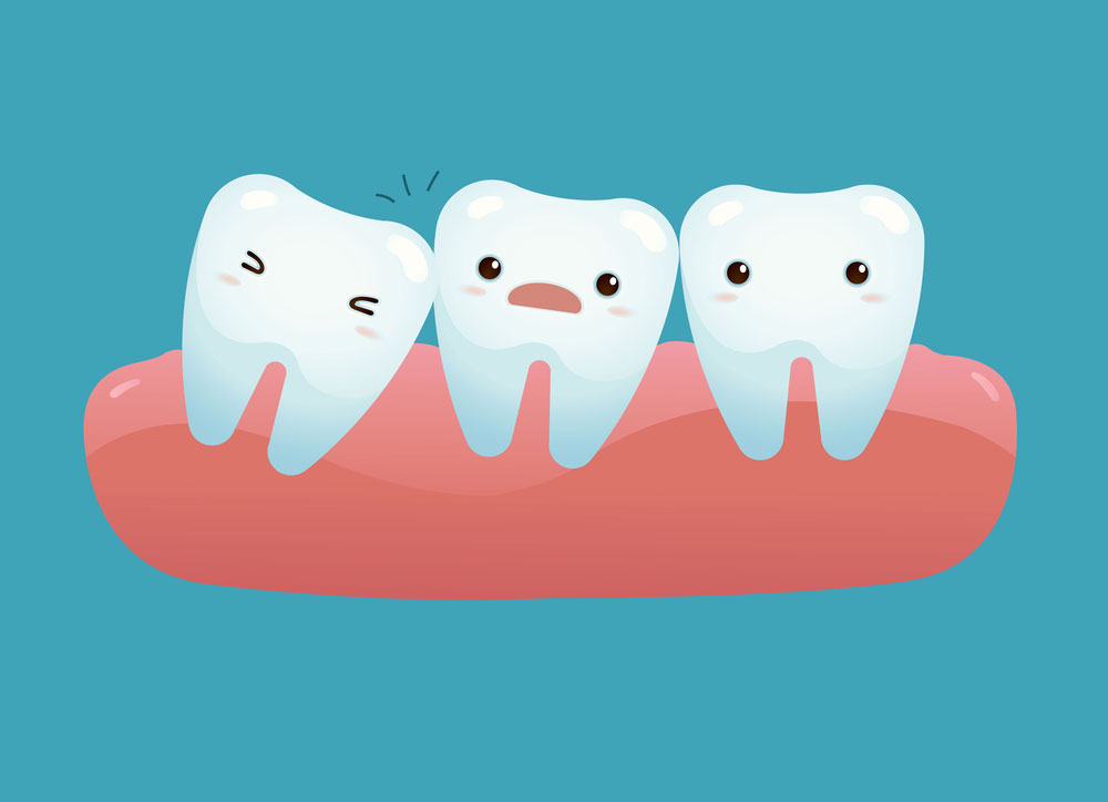 How Do I Know if my Wisdom Teeth Are Impacted?