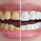 Dental Crowns - What are They?