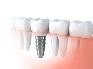 Dental implants in Regina and Saskatoon