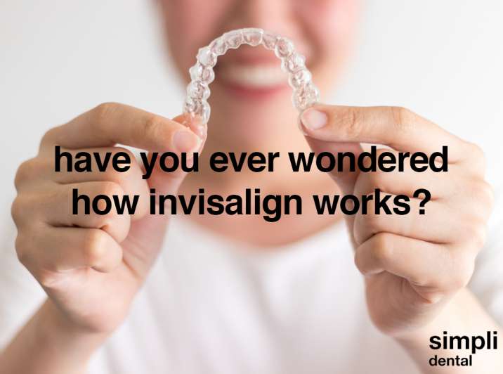 have you ever wondered how Invisalign works