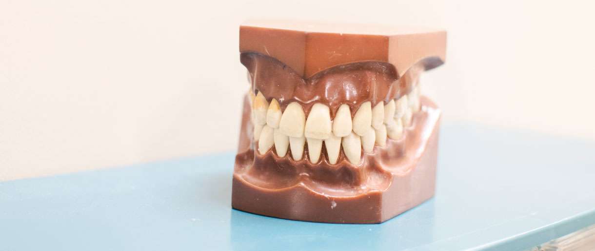 Mouth Model of Teeth Getting Veneers
